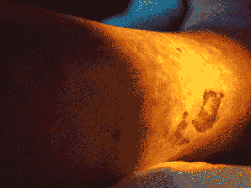 Understanding Pressure Ulcers: Prevention, Risks, and Treatment Options