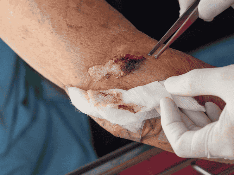The Future of Wound Care: How Technology is Transforming Healing
