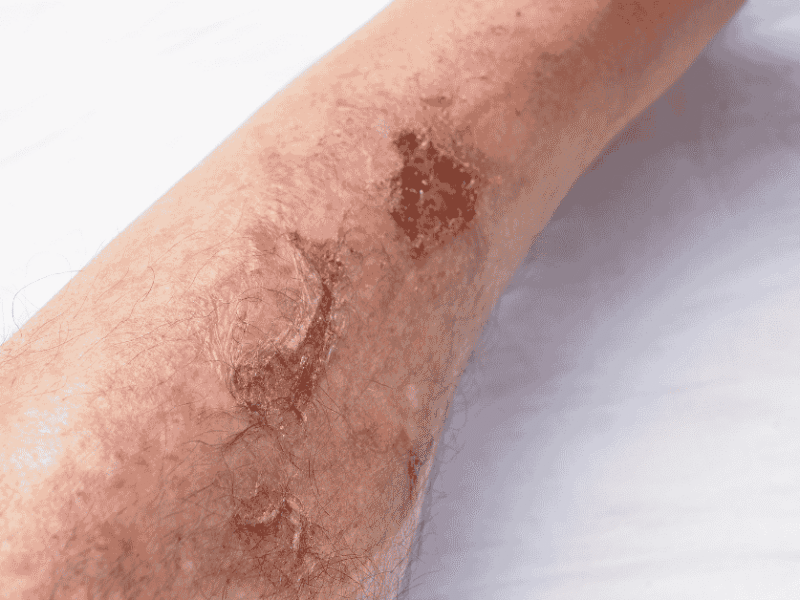 When to Worry: Why Some Wounds Don’t Heal on Their Own