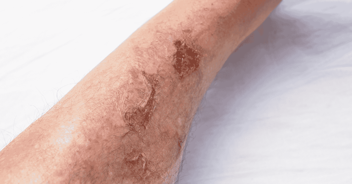 When to Worry: Why Some Wounds Don’t Heal on Their Own