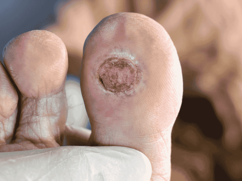 Diabetic Foot Ulcers: Early Warning Signs You Should Never Ignore