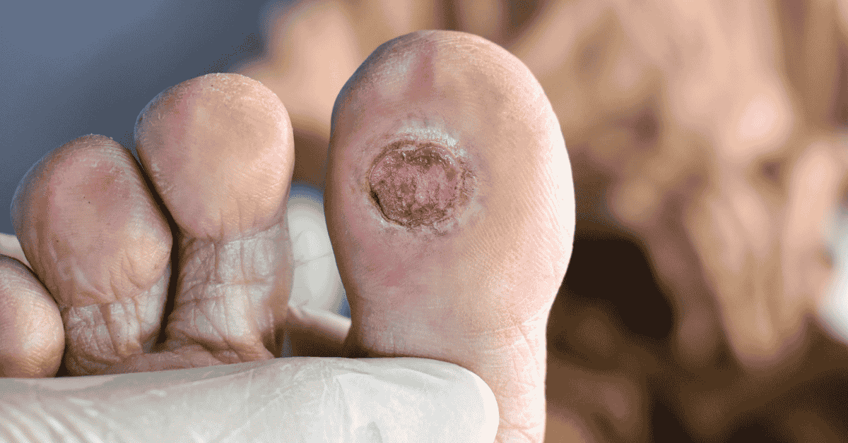 Diabetic Foot Ulcers: Early Warning Signs You Should Never Ignore