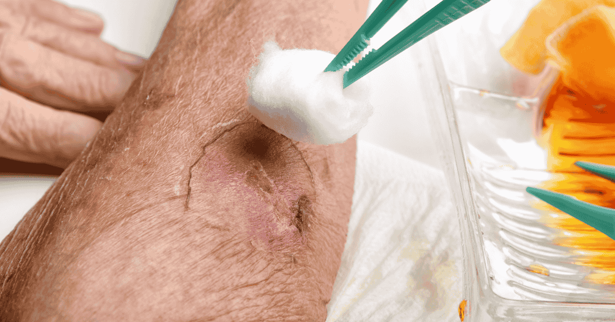 From Infection to Amputation: How Advanced Wound Care Helps Prevent Serious Complications