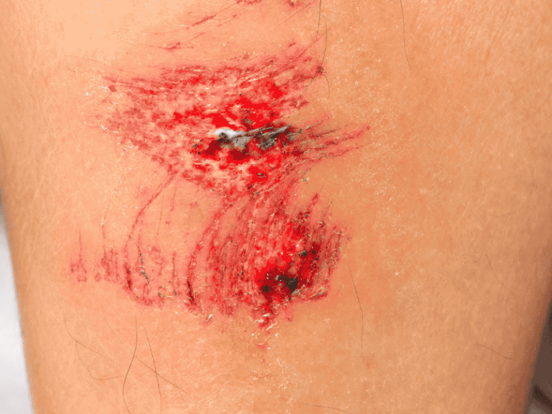 The Hidden Role of Poor Circulation in Slow-Healing Wounds