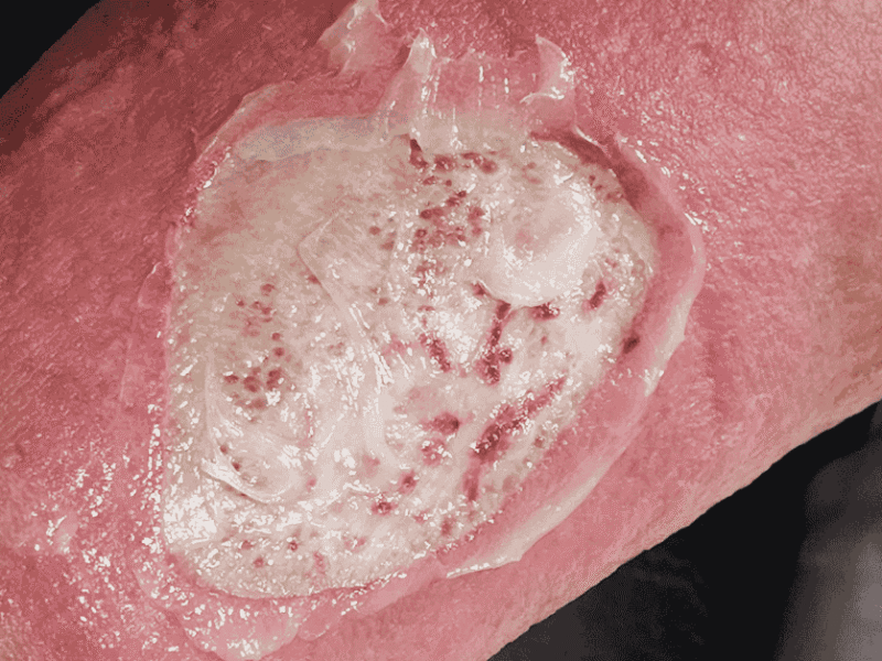 Pressure Ulcers Explained: Causes, Stages, and Modern Treatment Options