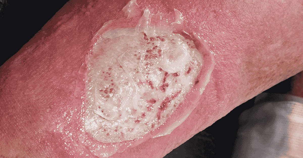 Pressure Ulcers Explained: Causes, Stages, and Modern Treatment Options