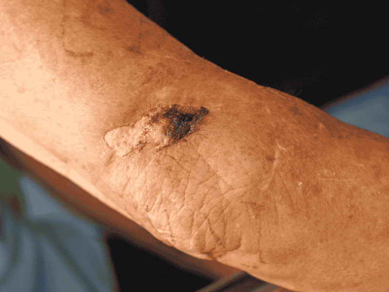Why Some Wounds Won’t Heal: Understanding Chronic Wounds