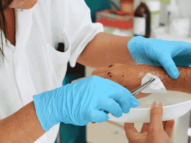 The Importance of Debridement in Wound Healing