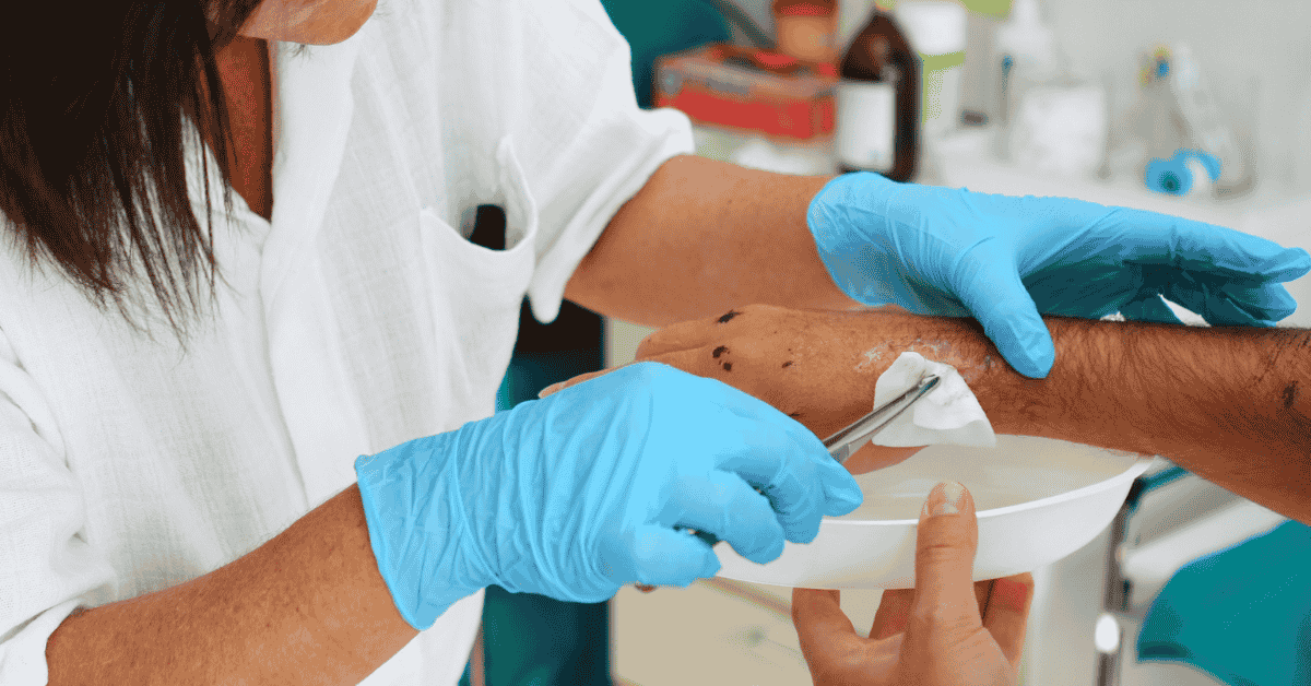 The Importance of Debridement in Wound Healing