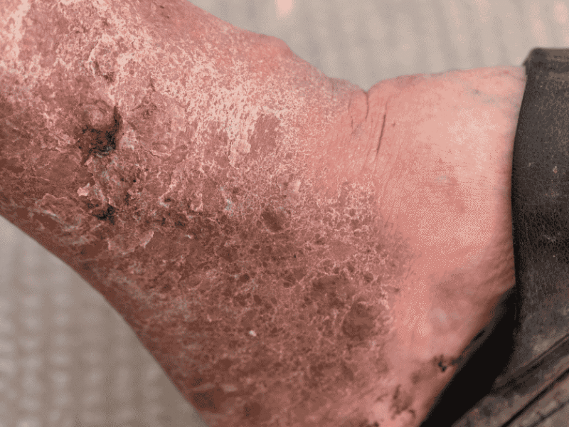 Venous Leg Ulcers: Causes, Symptoms, and Treatment