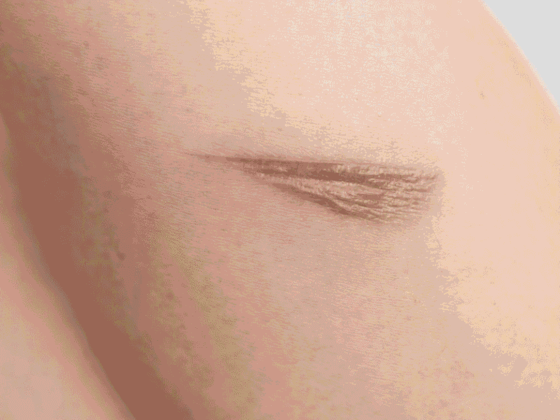 Why Your Wound Looks “Better” But Still Isn’t Healing