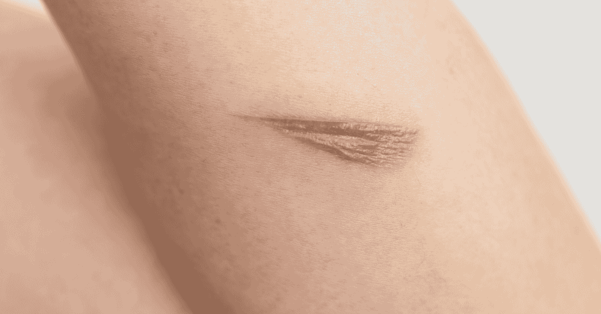 Why Your Wound Looks “Better” But Still Isn’t Healing