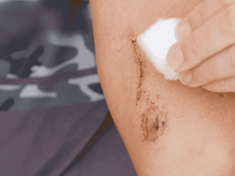What Happens If You Ignore a Chronic Wound?