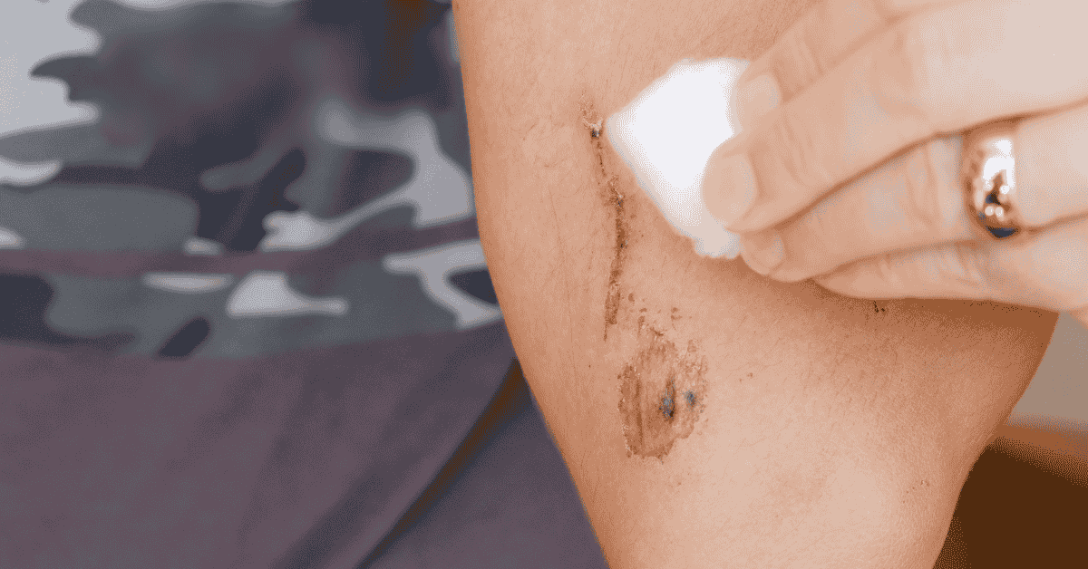 What Happens If You Ignore a Chronic Wound?
