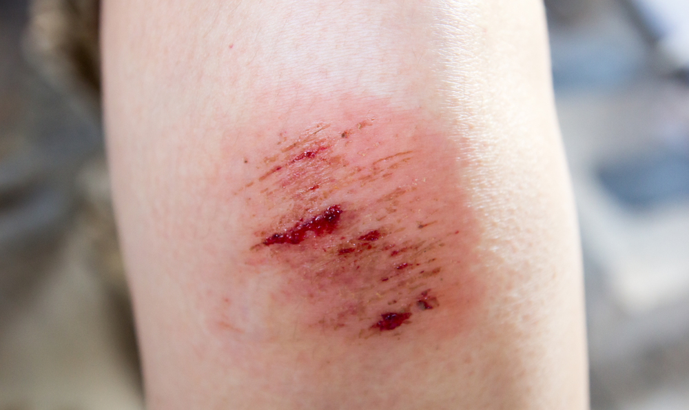 Wound Infection Treatment Phoenix: Signs You Should Not Ignore